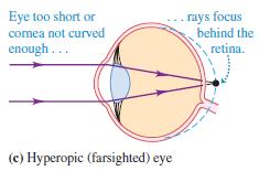 18 REFRACTIVE ERRORS The hyperopic (farsighted) eye has the opposite problem: The eyeball is too short or the cornea is not curved enough, and the image of an infinitely distant object