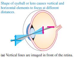Refractive Errors 20 Another common form of ametropia is astigmatism.