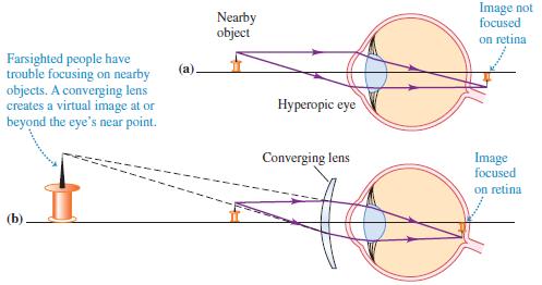 Refractive Errors All these defects can be corrected by the use of corrective lenses (eyeglasses or contact lenses) or, in recent years, by refractive surgery in which the cornea itself is reshaped.