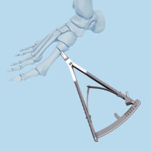 Implantation 2 Open osteotomy and measure Instrument 03.211.009 Opening Wedge Measuring Device Open the osteotomy using osteotomes or the opening wedge measuring device.