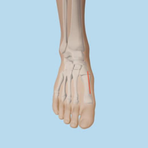 Approach Make a 3 to 4 cm dorsomedial incision from the first tarsal metatarsal (TMT) joint, distally along the midline of the first metatarsal.