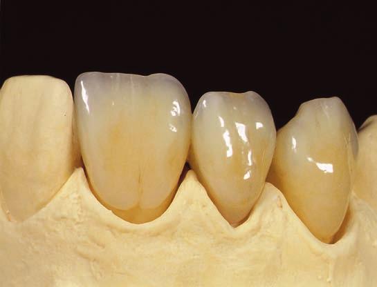 The glaze bake is carried out in the same way; working with Zirconia or metal restorations, and depending on individual ceramic furnaces, the bake should be between 780 c and 810m C (fig.