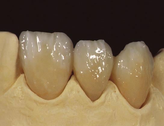 The IQ technique, the Vita Classical shades, and the individualized special case, can be compared visually with Fig 26: The desired Vita Classical tooth shades is more or less, intensively applied