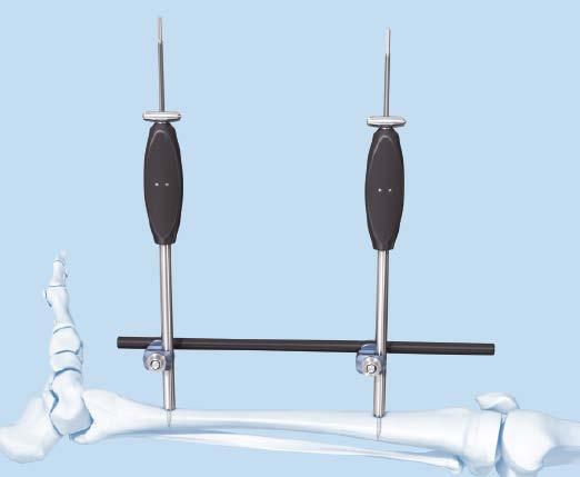 Toothed Reduction Handles (Bicortical) for Enhanced Rotational Stability 3 Reduce fracture Instruments for 3.0 mm threaded rods 390.031 Medium Combination Clamp, MR Safe 395.786 8.