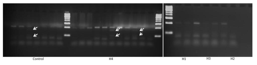 S-au identificat mutații ale genei AGT-Met235Thr și pentru subiecții din grupul control (Fig.