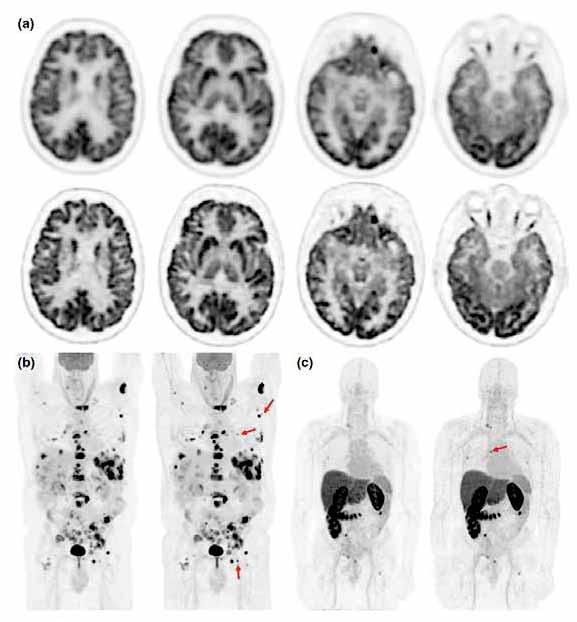 PAPA-ROS-HOTV (a) FDG Brain PET Upper row: OSEM Bottom row: PAPA-ROS- HOTV (b) FDG whole body PET, non- Hodgkin s lymphoma Left: OSEM Right: PAPA-ROS-HOTV (c)