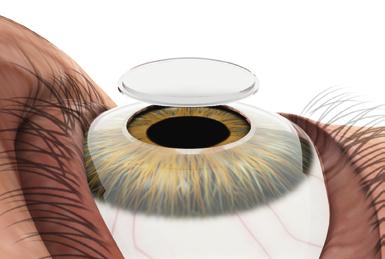 Clinical Applications Corneal Implant Planning The comes with a licensable corneal inlay software module which is optimized to patients with implanted corneal inlays.