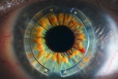 When planning an intracorneal ring surgery, corneal pachymetry, high order aberrations, curvature maps and total corneal astigmatism deliver the information needed to decide on the right ring and