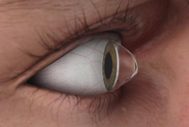 Keratoconus Screening The offers a complete dataset for Keratoconus screening.