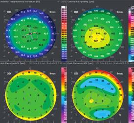 Unique Technology α Reliable surface data for refractive and corneal surgery The integrates Placido disc topography and Dual-Scheimpflug tomography in one device.