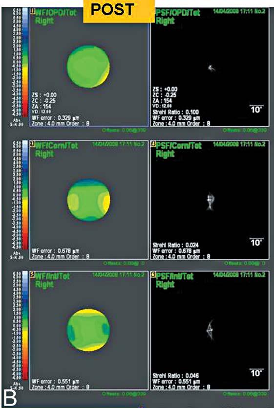 WF/OPD/Tot denotes the higher and lower order aberrations of all components of the eye combined; WF/Corn/Tot denotes the higher and lower order wavefront aberrations of the corneal front surface; and