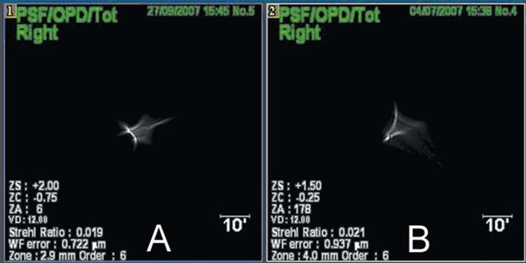 8-mm pupil diameter to the eighth Zernike order. Figure 4. Case 3. A) Point spread function (PSF) at distance and B) PSF due to accommodation of a patient with an incipient cataract.