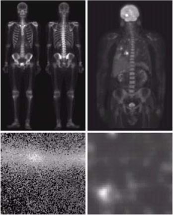 Gamma-Ray Imaging Nuclear Image (a) Bone scan (b) PET (Positron emission tomography) image