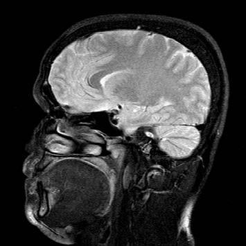 Fig.5: Brain CT Scan