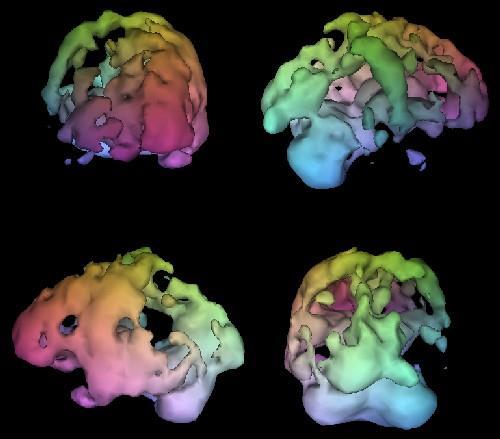 Fig.11: Brain SPECT Showing Alzheimer's disease Fig.12: PET scan III.