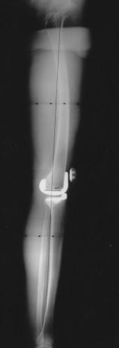 The problem has always been how to get a high-quality radiograph that can properly visualize the dense hip area without overexposing the less-dense knees and ankles.