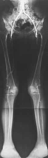 ..from hip to ankle...using just one x-ray exposure! With a single good exposure, the exact alignment deformity can be measured.