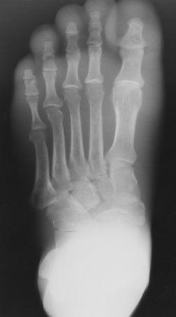 Until now, trying to obtain a uniform radiographic image of the foot has been a problem.