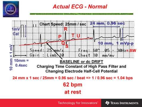 Here is an example of a normal ECG chart recoding for a heartbeat of 62bpm. The rate can be determined from the rate of R wave occurrences.