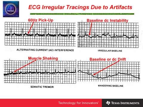 These displays provide examples of irregular ECG tracings caused by both internal and external factors.
