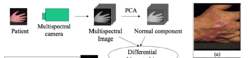 Multispectral imaging of psoriasis