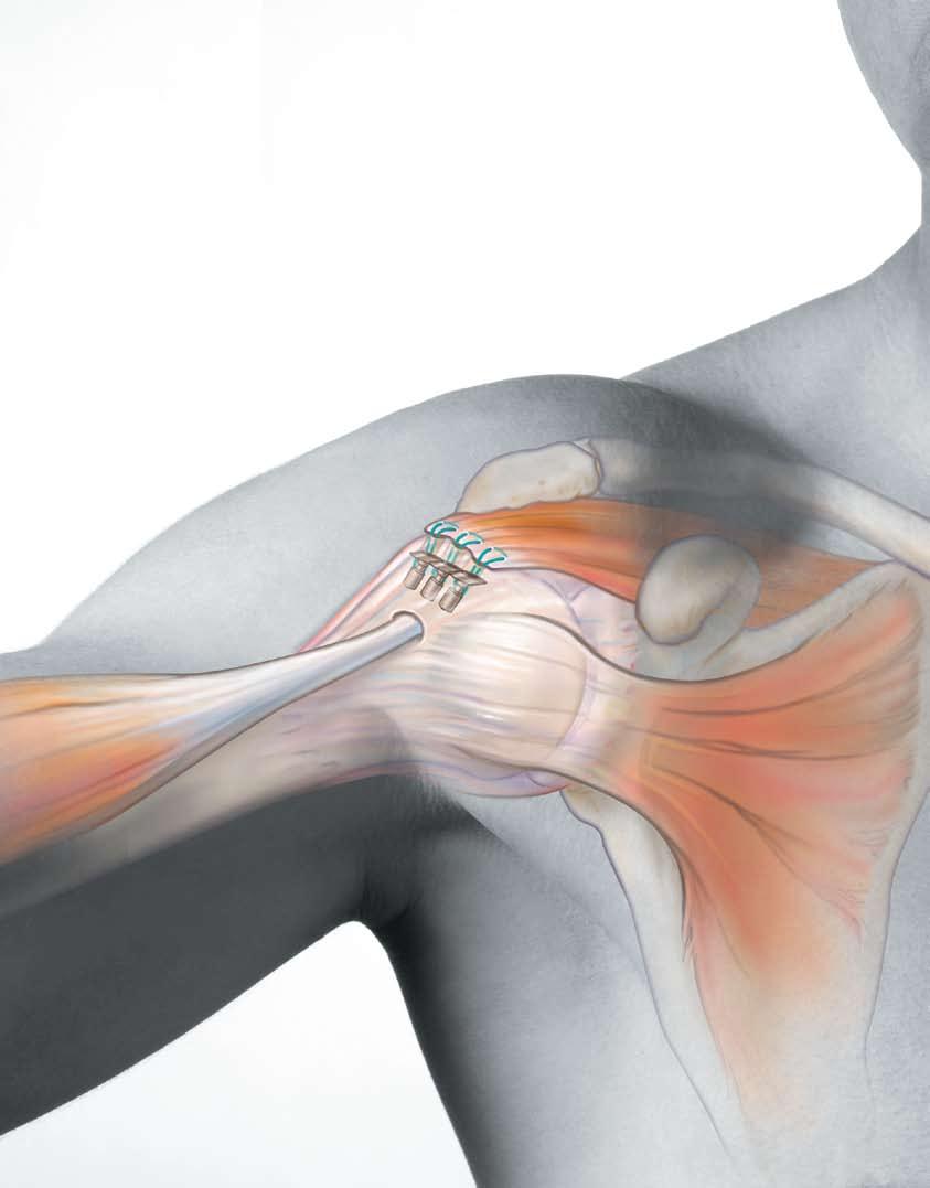 The OPUS AutoCuff System for Rotator Cuff Repair A revolutionary new system specifically designed for rotator cuff repair surgery System Includes: