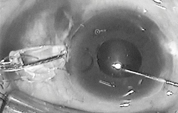 The viscoelastic material was washed out with gentle irrigation and aspiration. The corneal wound was left sutureless without wound leakage. Fig. 2.