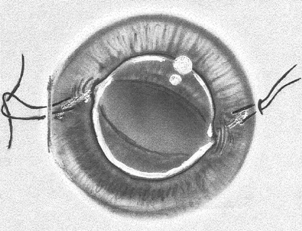 J.K. Wang, P.C. Lai Fig. 6. Both suture ends were retrieved from the corneal incision with a Sinskey hook. Fig. 7.