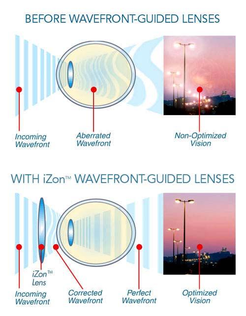Patient Benefits From izon by Definition Lenses " Fully optimized, high definition vision " Provides refractive correction near the physiological limits