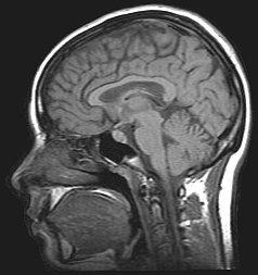 A brain MRI is a brain scan where we