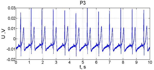 First electronic pulse setup with electrodes was tested by phantom pulse [5]. It ensures repeatability of measurement, because real time pulse read from human body is stochastic signal.