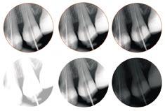 The result is that even small details like 0.06 mm root canal files are visible. In addition, the DIGORA Optime System virtually eliminates under- and overexposed images.
