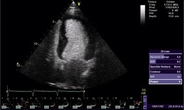 LVO Contrast* Get enhanced visualization of the LV border for diagnosing abnormalities
