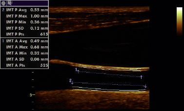 IMT Measurement Dramatically reduce the time and improve the accuracy of the carotid