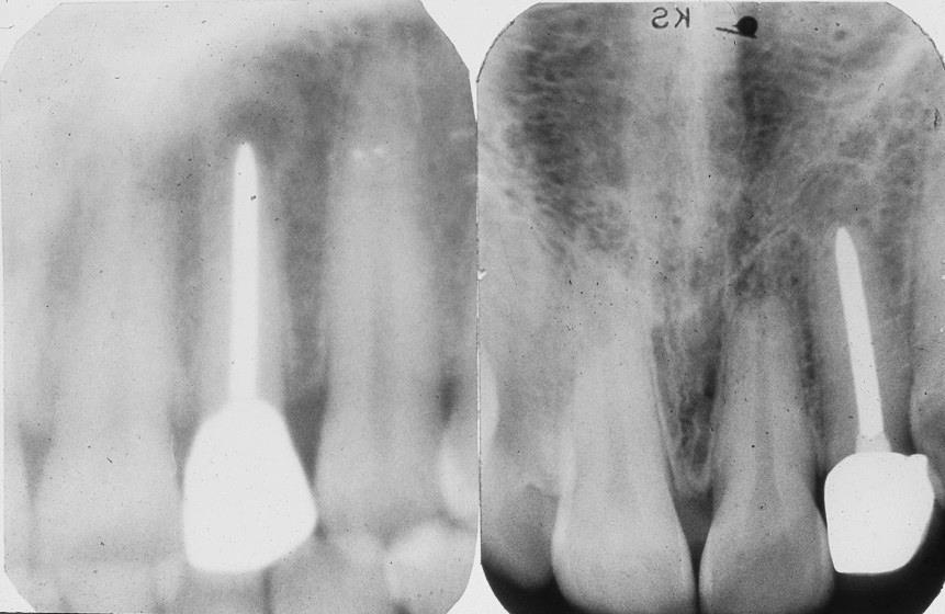 *In most dental applications,the best mean of reducing scattered radiation are: 1. Use a relatively low KVP.. 2. collimate the beam to the size of the film. 3. Use grid in extraoral radiography.
