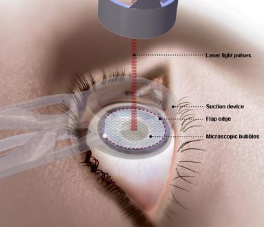 Near- and Mid-infrared Semiconductor Lasers Biomedical applications eye surgery infrared