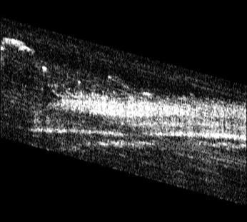 B&C show orthogonal B-scans (640x256 pixels; 970x460μm) of the 3D volume (A).