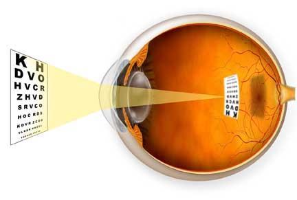 2. Near-sightedness (myopia) Near-sighted people can see nearby objects clearly but cannot bring