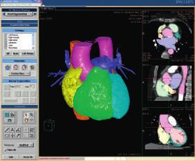 Philips EP navigator software helps to visualize 3D cardiac anatomy and the position of catheters, in real time, in one image, in the EP interventional lab.