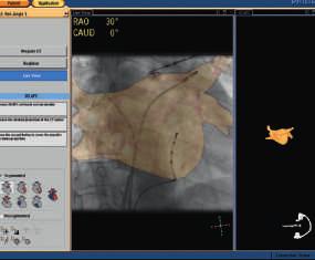 Live view The registered image shows the position of any catheter in relation to the 3D