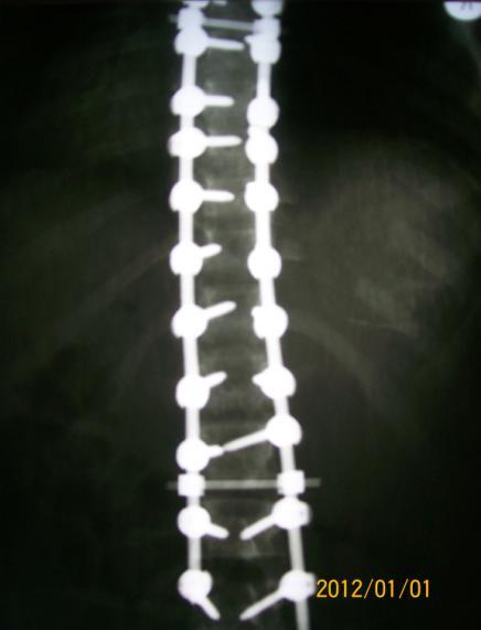 partea concavă, tenoligamentocapsulotomia după Şulutсo, spondelodeza posterioară cu ajutorul autotransplantului din crista iliacă sau din coaste, obţinute la toracoplastie. Fig 3.
