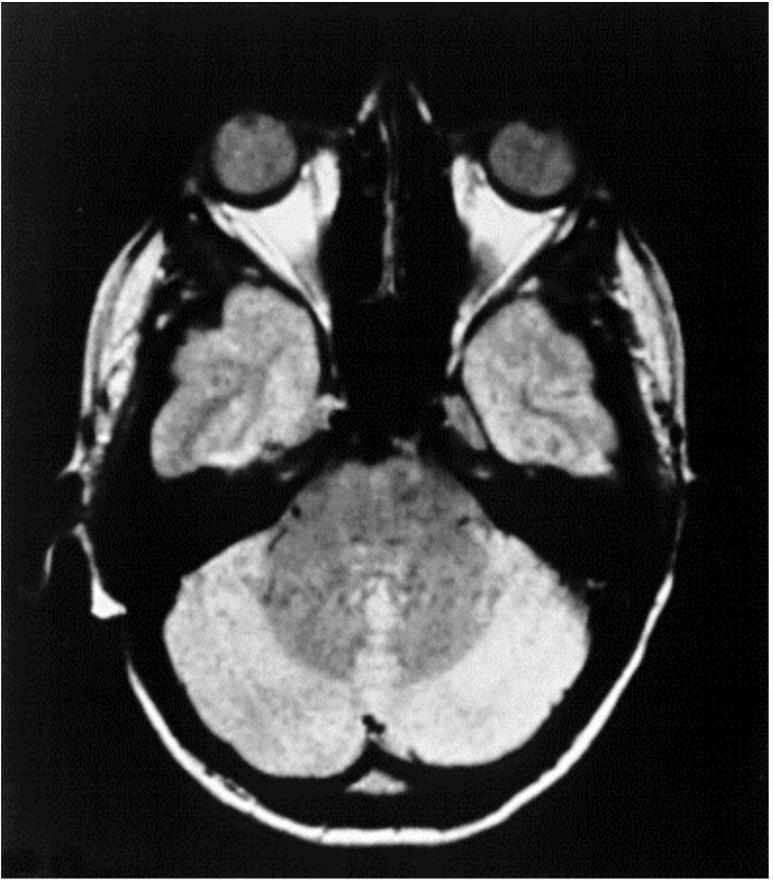 Epilepsy XBB 893-2245A NMR