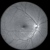 EIDON improves retinal diagnostics capabilities in that it offers: Greater contrast than a traditional fundus camera Preserved image