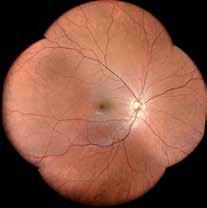 5 mm pupil No optic disc bleaching No saturation of the red channel like in traditional fundus cameras Multiple confocal imaging