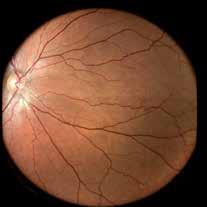 Red-free is useful to enhance the visibility of the retinal vasculature and retinal nerve fiber layer Infrared (825 870 nm) provides