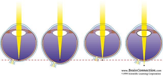Light Lens Focal plane Emmetropia (normal) Myopia