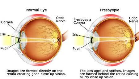 Presbyopia (age