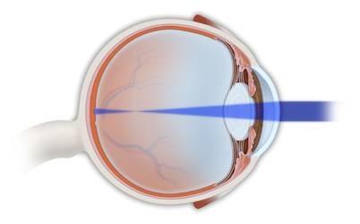 Refractive errors: myopia In myopia (nearsightedness), there is too much optical power in the eye.