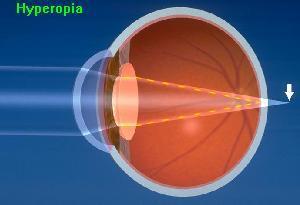 Focusing Problems HYPEROPIA Far-sightedness Problem seeing close objects Distance
