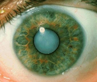 Diseases of the Eye CATARACTS Clouding forms